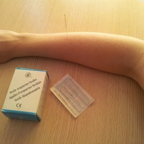 Acupuntura e equilíbrio